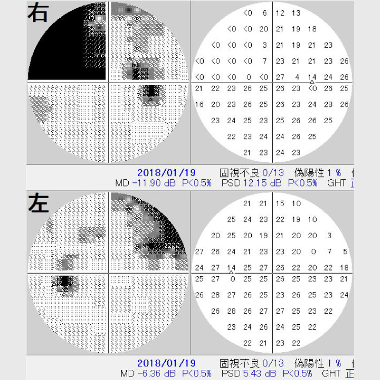 緑内障